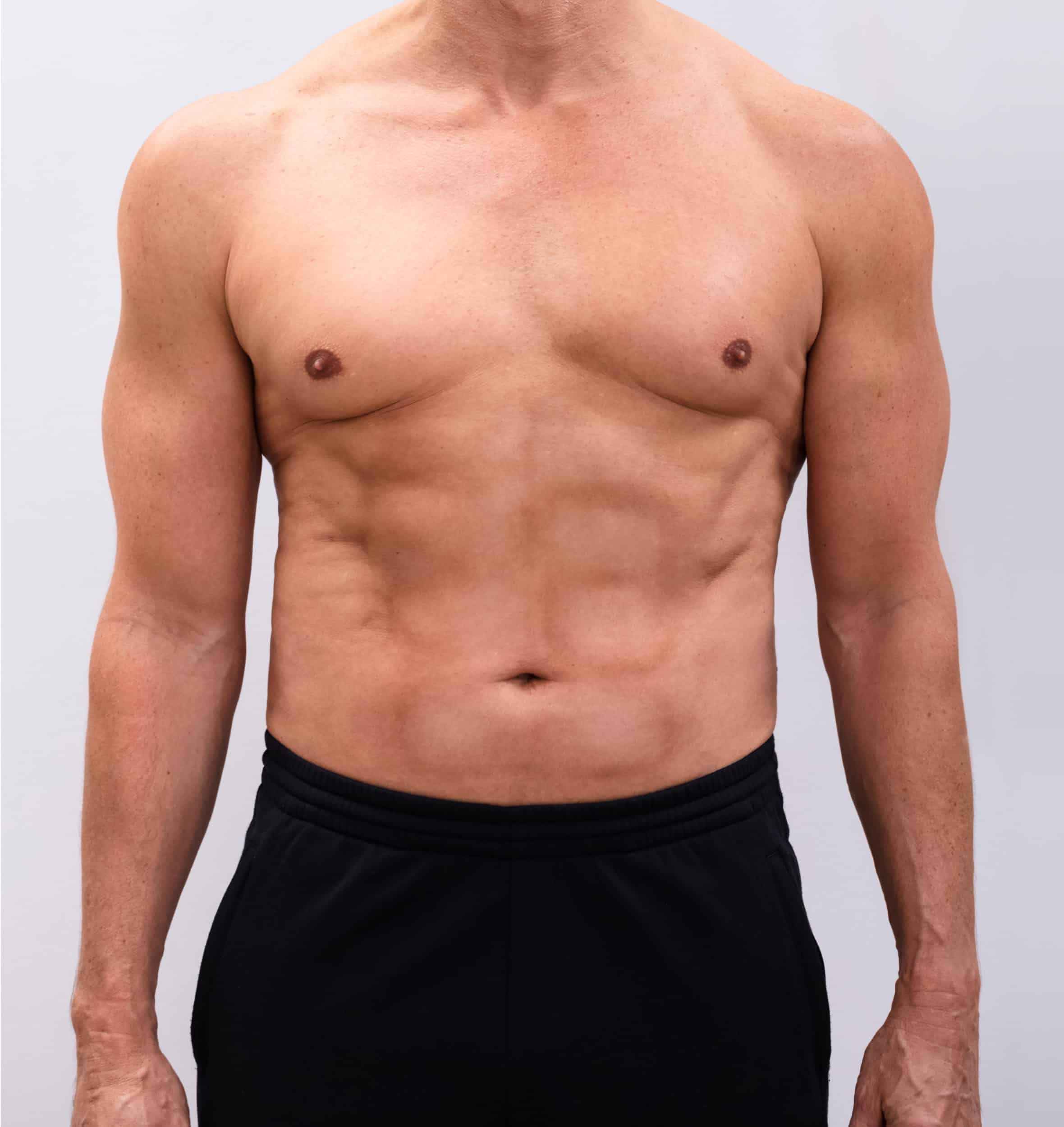 After Image: Tummy Tuck 5 - front