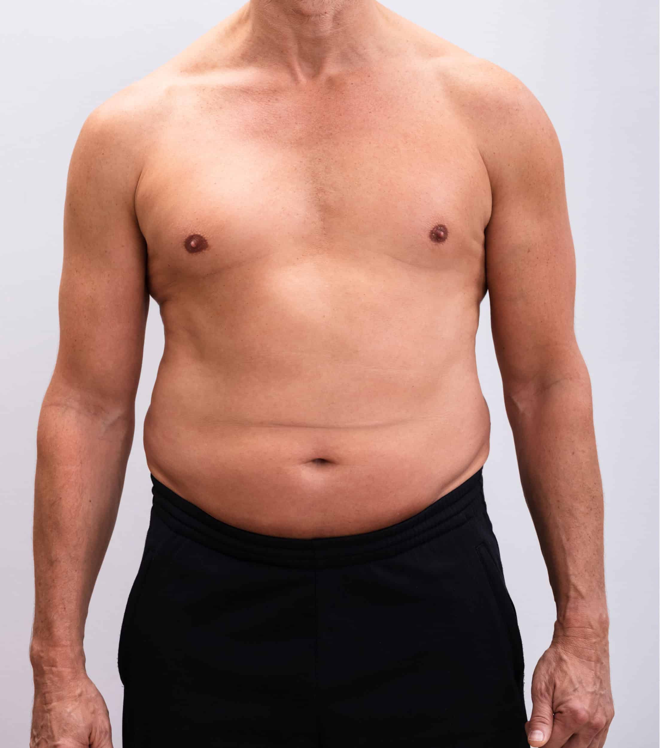 Before Image: Tummy Tuck 5 - front