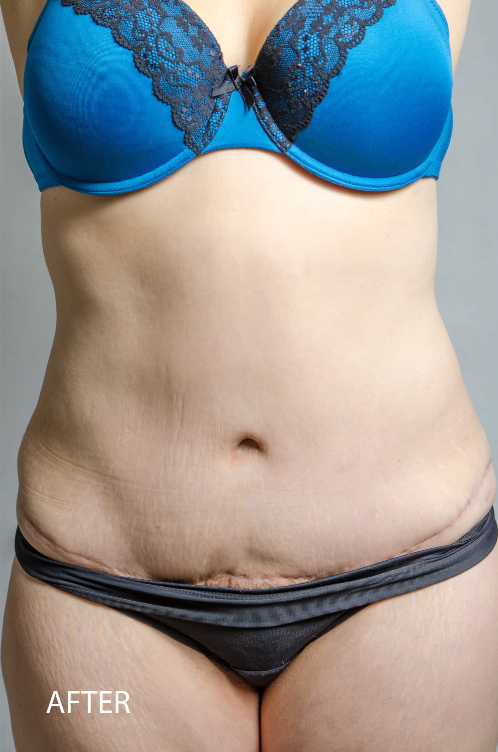 After Image: Tummy Tuck 4 - front