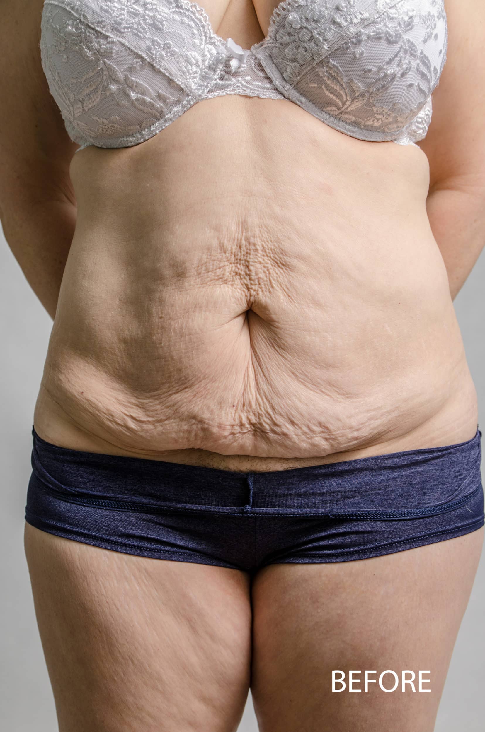 Before Image: Tummy Tuck 4 - front